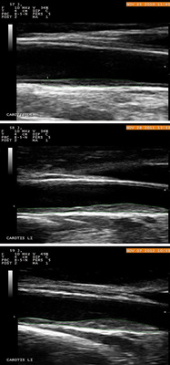 
 Abb. 4: 
 Plaqueprogression innerhalb eines Jahres mit Flächenvergleich (grüne gepunktete Linie)



