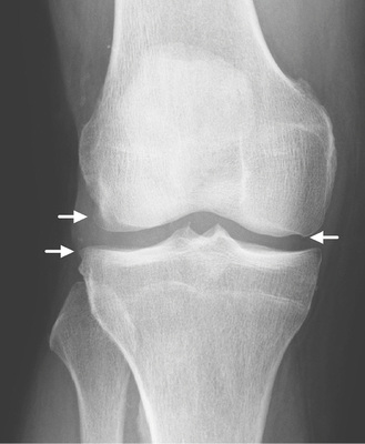 
 Abb. 1: 
 Kellgren-Lawrence-Grad 1, mögliche Osteophyten medial am Femur sowie lateral am Femur und Tibia (weiße Pfeile)



