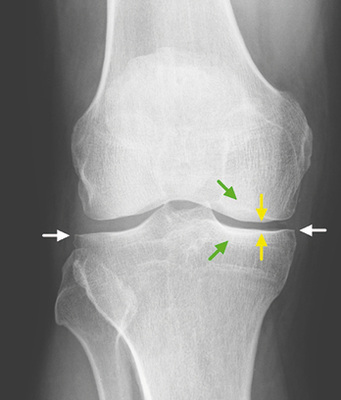 <p>
<span class="GVSpitzmarke"> Abb. 2: </span>
 Kellgren-Lawrence-Grad 2, minimale Osteophyten medial und lateral an der Tibia (weiße Pfeile), leichte mediale Gelenkspaltverschmälerung (gelbe Pfeile) und moderate subchondrale Sklerose des medialen femorotibialen Kompartimentes (grüne Pfeile)
</p>

<p class="GVBildunterschriftEnglisch">
</p>