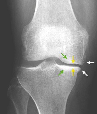 
 Abb. 3: 
 Kellgren-Lawrence-Grad 3, multiple Osteophyten (weiße Pfeile, klein auch an der latera-len Tibia) mit definitiver Gelenkspaltverschmälerung (gelbe Pfeile) und subchondraler Sklerose des medialen femorotibialen Kompartimentes (grüne Pfeile). Initiale Verformung des medialen Femurs und Tibia



