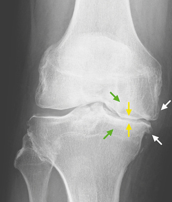 
 Abb. 4: 
 Kellgren-Lawrence-Grad 4, ausgeprägte Osteophyten (weiße Pfeile), Gelenkspaltverschmä-lerung (gelbe Pfeile) und subchondrale Sklerose (grüne Pfeile). Die Deformation des medialen femorotibialen Kompartimentes mit dem abfal-lenden Slope des medialen Tibialplateaus ist gut sichtbar



