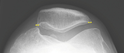 
 Abb. 5: 
 Definiter Osteophyt entsprechend der Konsensusempfehlung BK 2112: Ausziehung einer Größe  2 mm ab antizipierter Knochenform des Gelenkrandes



