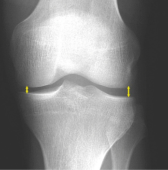 
 Abb. 6: 
 Mediale Gelenkspaltverschmälerung ohne begleitende osteophytäre Anbauten (atrophe Arthroseform)



