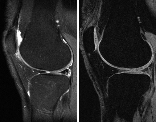 
 Abb. 7: 
 Die moderat T2-gewichtete fettgesättigte Turbospinecho Sequenz (links) zeigt eine gute Ab-grenzbarkeit des Knorpels zur Gelenkflüssigkeit sowie intrakartilaginäre Matrixveränderungen, während die T1-gewichtete wasserangeregte Gradientenechosequenz (rechts) eine gute Darstellung der Knorpel-dicke zeigt. Beide Sequenzen bieten also komplementäre Informationen über den Knorpel



