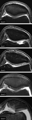 <p>
<span class="GVSpitzmarke"> Abb. 8: </span>
 Chondropathie am Beispiel des Retropatellarknorpels in einer mode-rat T2-gewichteten Sequenz mit Fettsättigung in axialer Akquisition. Gradeinteilung nach Vallotton (s. Tabelle 4). Grad 0 entspricht einem gesunden intakten Knorpel
</p>

<p class="GVBildunterschriftEnglisch">
</p>