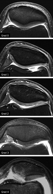 
 Abb. 8: 
 Chondropathie am Beispiel des Retropatellarknorpels in einer mode-rat T2-gewichteten Sequenz mit Fettsättigung in axialer Akquisition. Gradeinteilung nach Vallotton (s. Tabelle 4). Grad 0 entspricht einem gesunden intakten Knorpel



