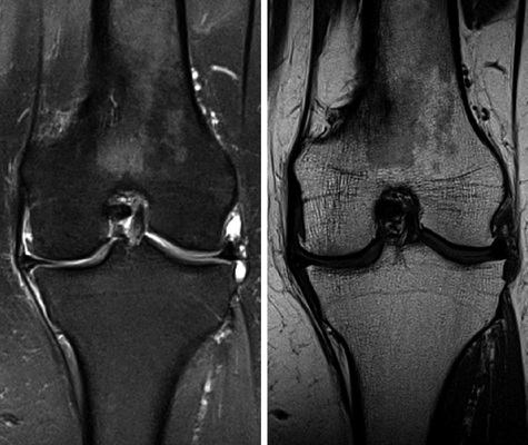 
 Abb. 9: 
 Mediale Gonarthrose mit Knorpeldickenreduktion, Meniskushöhenminderung und -extrusion. Mediale und laterale femorale Osteophyten. Geringer Gelenkerguss. Koronale moderat T2-gewichtete fett-gesättigte (links) und T1-gewichtete (rechts) Sequenz



