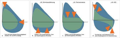 
 Abb. 9: 
 Krankheitszeichen; 
a
 Restriktion, 
b
 variable extrathorakale Stenose, 
c
 variable intrathorakale Stenose und 
d
 extrathorakale Stenose. VCD = vocal cord dysfunction
