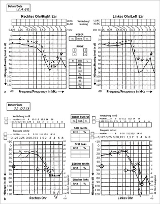 
 Abb. 1: 
 a Landwirt, zum Zeitpunkt der Untersuchung 72 Jahre alt, Anerkennung einer Lärmschwerhörigkeit. b Derselbe Landwirt 15 Jahre später: geringfügig zugenommene Schwerhörigkeit, Lärm ist aber noch die wesentliche Ursache



