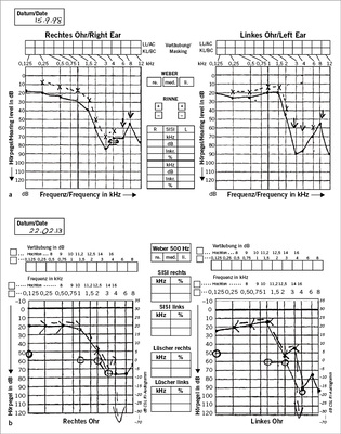 <p>
<span class="GVSpitzmarke"> Abb. 1: </span>
 a Landwirt, zum Zeitpunkt der Untersuchung 72 Jahre alt, Anerkennung einer Lärmschwerhörigkeit. b Derselbe Landwirt 15 Jahre später: geringfügig zugenommene Schwerhörigkeit, Lärm ist aber noch die wesentliche Ursache
</p>

<p class="GVBildunterschriftEnglisch">
</p>