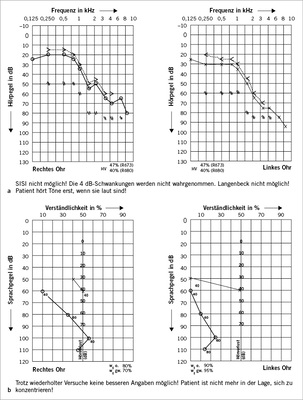 <p>
<span class="GVSpitzmarke"> Abb. 2a,b: </span>
 Landwirt, 73 Jahre, 50 Jahre nach Arbeitsunfall mit damaliger Anerkennung einer kom-bi-nierten Hörstörung links und beruflicher Lärmeinwirkung. Keine typische Lärmschwerhörigkeit, keine Folgen des Arbeitsunfalls audiometrisch zu erkennen. Hoher Diskriminationsverlust im Sprach-audiogramm
</p>

<p class="GVBildunterschriftEnglisch">
</p>