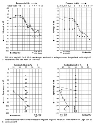 
 Abb. 2a,b: 
 Landwirt, 73 Jahre, 50 Jahre nach Arbeitsunfall mit damaliger Anerkennung einer kom-bi-nierten Hörstörung links und beruflicher Lärmeinwirkung. Keine typische Lärmschwerhörigkeit, keine Folgen des Arbeitsunfalls audiometrisch zu erkennen. Hoher Diskriminationsverlust im Sprach-audiogramm




