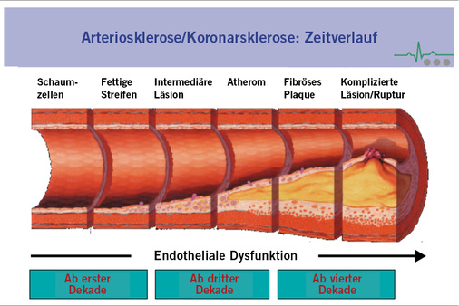 
 Abb. 2: 
 Zeitverlauf der Koronarsklerose (Pepine 1998)
