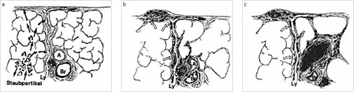 
 Abb. 1: 
 Pulmonale Staubaufnahme. 



a Phase der pulmonalen Staubaufnahme und der interstitiellen Inkorporation = Phase I. 



b Phase der Reaktion und Fibrose = Phase II. 



c Phase der Komplikationen = Phase III 



(A = Pulmonalarterie; Br = Bronchiolus; Ly = Lymphgefäß). Aus: Müller u. Grewe 1992



