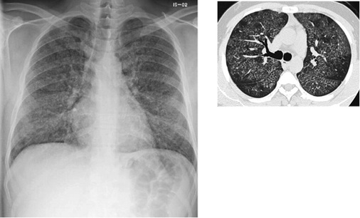 
 Abb. 2: 
 Akute Silikose (Silikoproteinose). 






DD: Ödem, bronchioalveoles Karzinom, Blutung, Alveolarproteinose.



Sammlung J. Parker: 46-jähriger Patient, Phosgeninhalation (schwer wasserlösliches Gas mit vorwiegend alveolärer Reaktion, bildmorphologisch vergleichbar mit akuter Silikose)



