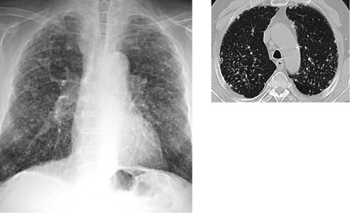 
 Abb. 3: 
 Chronische Silikose. 78-jähriger Patient. Langjährige Tätigkeit mit obertägiger Quarzstaubexposition




