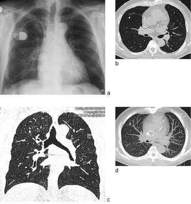 
 Abb. 4: 
 Niedrig gestreute Silikose. 



Expertenmeinung zu a q/q 1/1 sowie 1/0 und 0/1; 



b 1-mm-Schicht; 



c koronal zur Demonstration enges Fenster; 



d MIP –10 mm: Gesamt-Score nach ICOERD 4



