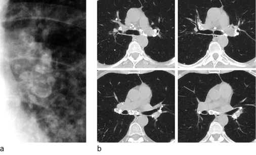 
 Abb. 5: 
 Eierschalensilikose. a Ausschnitt Hilus mit typischen Eierschalenlymphknoten; b im ST auch mediastinaler und re-hilärer Befund




