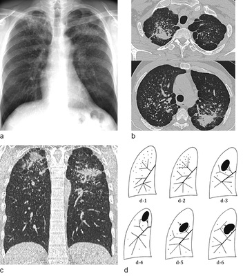 
 Abb. 6: 
 a–c Schwielenbildung in beiden Oberfeldern, Ausmaß der koaleszierenden Noduli erst im CT exakt einzuschätzen; typische Lokalisation in den dorsalen Oberfeldern. 



d „Schwielenwanderung“ nach Bohlig (1988): d-1 bis d-6. Schematische Darstellung des Verlaufs einer silikotischen Ballung im rechten Oberlappen (d-1 bis d-3) mit „Reinigung des Lungenfeldes“ und Bündelung bzw. Überspreizung der Segmentbronchien; weiterer Verlauf bei Wanderung der Schwiele zur Lungenspitze (d-4), zum Hilus mit Verdrängungsüberspreizung von Segmentbronchien (d-5) oder Stenosierung des gesamten Oberlappens (d-6)



