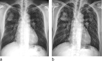 <p>
<span class="GVSpitzmarke"> Abb. 7: </span>
 Schwielen und Tuberkulose. Zwischen a und b 1 Jahr Abstand, Tuberkulose bestätigt, Therapie eingeleitet
</p>

<p class="GVBildunterschriftEnglisch">
</p>