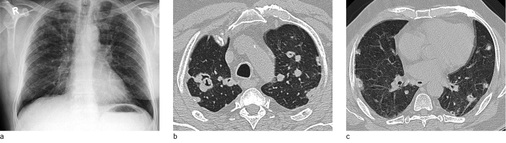 <p>
<span class="GVSpitzmarke"> Abb. 9: </span>
 Caplan-Syndrom. 60-jähriger Patient, BK 4101 anerkannt ohne Entschädigung, laufende Behandlung wegen rheumatoider Arthritis. Seit 2007 progrediente noduläre Herde auf der Thoraxübersicht. a Thoraxübersicht 2012 als Silikose A q/r 3/3 klassifiziert, Verdacht auf Caplan-Syndrom. 
</p>

<p>
b und c CT vor histologischer Abklärung, zahlreiche eingeschmolzene Rundherde; VAT rechts, Keilresektion aus Mittellappen. Histologie: subpleuraler Rheumaknoten mit granulomatöser histiozytärer Reaktion; Staubablagerungen mit Silikatkristallen und Anthrakose
</p>

<p class="GVBildunterschriftEnglisch">
</p>