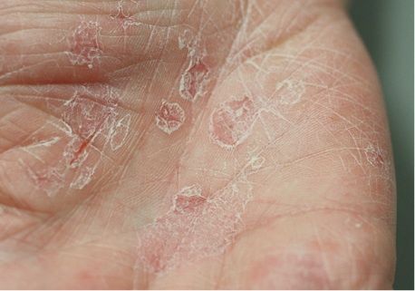 
 Abb. 2: 
 Psoriasis mit typischer halskrausenartiger Schuppung
