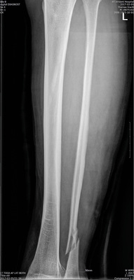 
 Abb. 5: 
 Telemedizinisch übermitteltes Röntgenbild einer Unterschenkelfraktur

