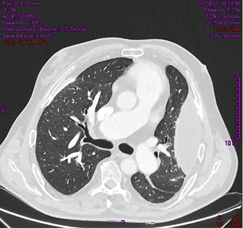 <p>
<span class="GVSpitzmarke"> Abb. 3: </span>
 Computertomogramm des Thorax (Lungenfenster) vom 24.01.2017: Aufnahme kurz unterhalb der Carina
</p>