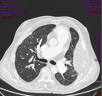 
 Abb. 3: 
 Computertomogramm des Thorax (Lungenfenster) vom 24.01.2017: Aufnahme kurz unterhalb der Carina
