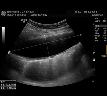 
 Abb. 5: 
 Kontroll-Sonographie linker Thorax vom 25.04.2017
