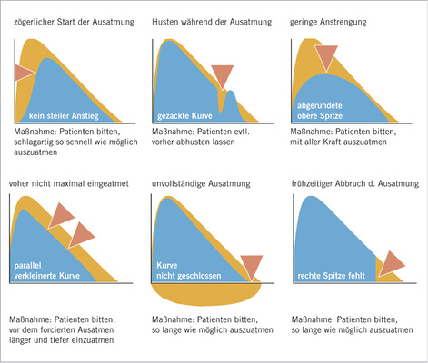 
 Abb. 3: 
 Fehlerzeichen, Qualitätsmängel (gelber Kurvenbereich = optimale Mitarbeit). Aus Criée et al. 2015
