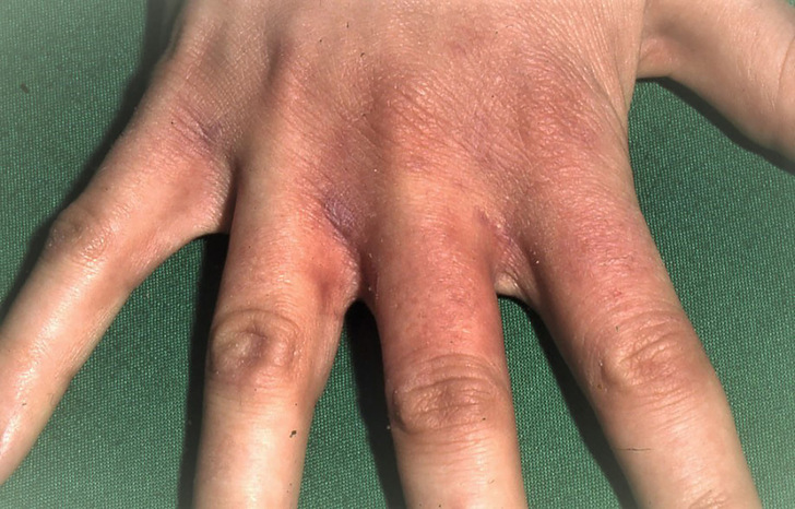 Abb. 1:    Beginnendes akutes irritatives Kontakt­ekzem mit Rötungen und diskreter Schuppung zwischen den Fingern, den Fingerseitenkanten und dem distalen Handrücken - © Foto: M. Fartasch
