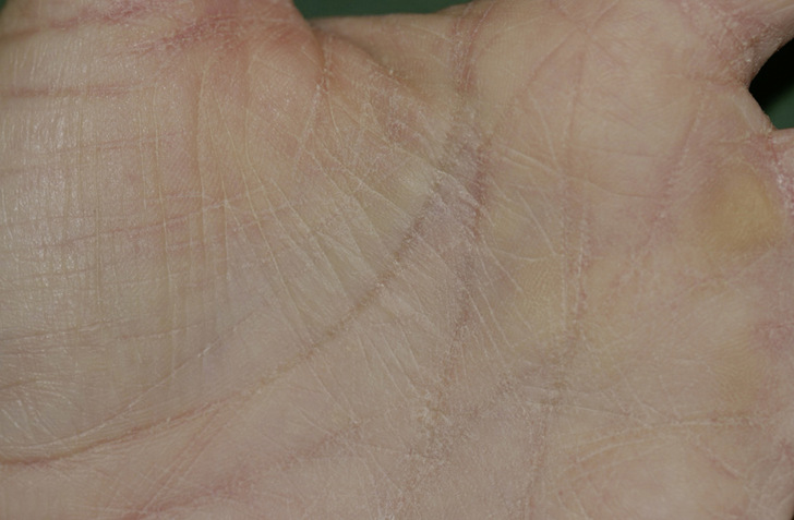 Abb. 1:   Beginnendes Ekzem (Handinnenfläche) mit rauer und trockener Haut bei Waschzwang - © Foto: Hautklinik Spandau/Harth
