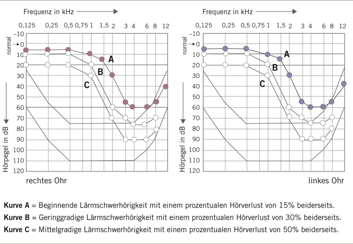 Abb. 1:   Typische tonaudiometrische Bilder der Lärmschwerhörigkeit. Alle Tonaudiogramme zeigen eine lärmtypische Senkenbildung im Bereich der hohen Frequenzen. Eine Senkenbildung ist durch eine Knickbildung am Übergang von den mittleren zu den hohen Frequenzen und durch einen Wiederanstieg der Kurve im ganz hohen Frequenzbereich gekennzeichnet (Brusis 2021, 2022)