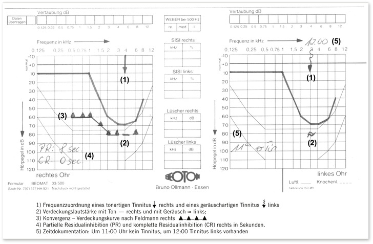 Abb. 1:   Dokumentation der Ergebnisse eines Tinnitus-Matching im Tonaudiogrammformular ( DGUV 2020; Feldmann u. Brusis 2019) . Beiderseitige Hochtonsenke als Zeichen einer chronischen Lärmschädigung des Innenohres (Lärmschwerhörigkeit) vorhanden
