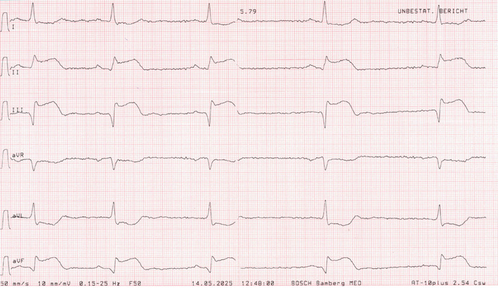 Abb. 1:    Extremitäten-EKG-Ableitungen Abb. 1:    Extremitäten-EKG-Ableitungen