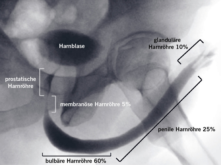 Abb. 1:    Zysturethrogramm einer gesunden Harnröhre mit Darstellung der anatomischen Abschnitte und Angabe der prozentualen Häufigkeit der Strikturen (mod. nach Tritschler et al. 2013a)