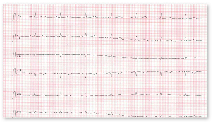 Abb. 1:    Extremitäten-EKG-Ableitungen