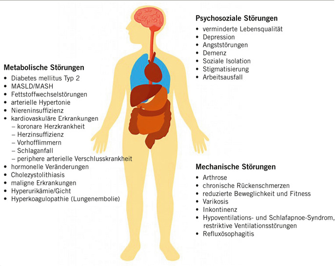 Abb. 1:    Adipositas-assoziierte Komorbiditäten, adaptiert nach (Laubner 2023). MASLD = Metabolic Dysfunction-associated Steatotic Liver Disease; MASH = Metabolic Dysfunction-associated Steatohepatitis (eigene Darstellung ??)