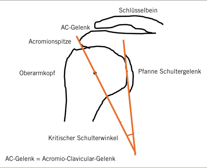Abb. 1:    Schultergelenk mit kritischem Schulterwinkel (eigene Darstellung)
