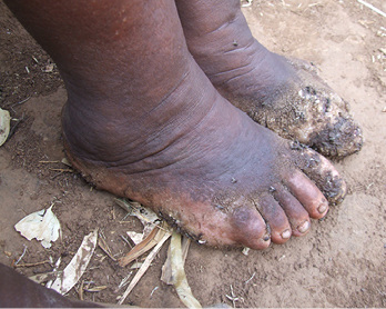 <p>
</p>

<p>
<span class="GVSpitzmarke"> Abb. 1: </span>
 Podokoniose mit verruköser Elephantiasis im Sodo Christian General Hospital in Äthiopien
</p> - © © U. Schwarz

