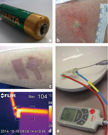 
 Abb. 1: 
 a VARTA
®
 Akku Typ AA Ni-MH 1,2V, 2500 mAh. b Wunddokumentation. c Wund-dokumentation (4 Monate nach Ereignis). d Versuchsaufbau ( BASF GCP/RR). e Wärmebild-kamera (Fotos: a–c  BASF GUA/ASA); d,e  BASF GCP/RR
