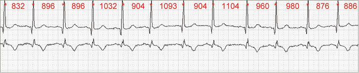 <p>
<span class="GVSpitzmarke"> Abb. 1: </span>
 Prinzip der Ermittlung der NN-Intervalle aus dem EKG als Abstandsmaß zwischen zwei R-Zacken
</p>