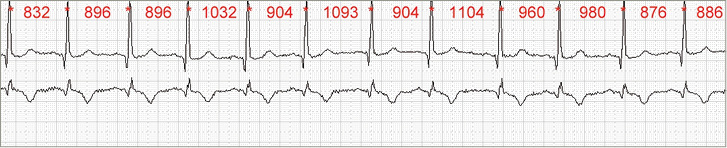 
 Abb. 1: 
 Prinzip der Ermittlung der NN-Intervalle aus dem EKG als Abstandsmaß zwischen zwei R-Zacken
