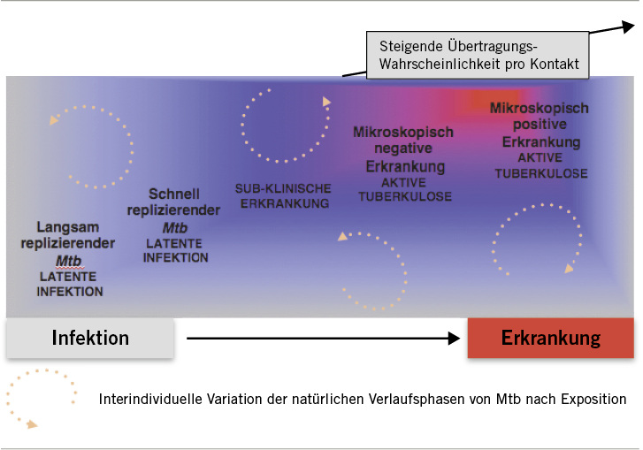 
 Abb. 1: 
 Spektrum der Tuberkulose nach Infektion. Es handelt sich dabei nicht um einen linear progressiven Prozess. Patienten können jederzeit in einer Phase verbleiben oder sehr schnell von einer Phase in die nächste fortschreiten
