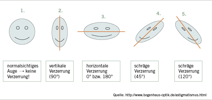 
 Abb. 1: 
 Astigmatismus – Korrektur mit Zylindergläsern
