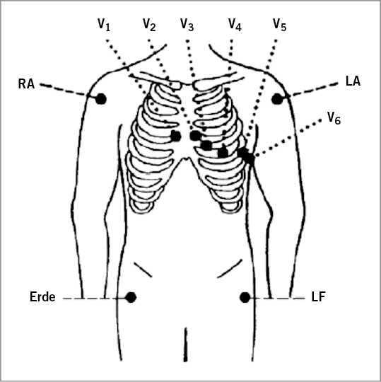 <p>
<span class="GVSpitzmarke"> Abb. 1: </span>
 Platzierung der Brustwand- und Extremitätenelektrode beim Belastungs-EKG. V1: 4. ICR parasternal re.; V2: 4. ICR parasternal li.; V3: zwischen V2 und V4; V4: 5. ICR in der Medioklavikularlinie li. (normalerweise Herzspitze); V5: vordere Axillarlinie in Höhe von V4 li.; V6: mittlere Axillarlinie in Höhe von V4 li.
</p>