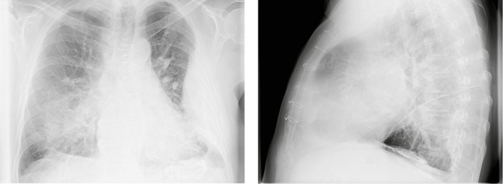 
 Abb. 1a,b: 
 Röntgen-Thorax in 2 Ebenen vom 16.01.2017
