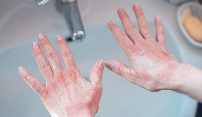 Die aufgrund der Corona-Pandemie intensivierten Maßnahmen der Handhygiene tragen ein nicht unerhebliches Gesundheitsrisiko 
im Sinne der Entstehung irritativer Handekzeme mit sich