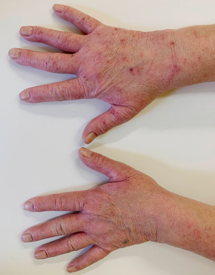 Abb. 1:    Chronisches Handekzem bei einer 56-jährigen Backwarenverkäuferin